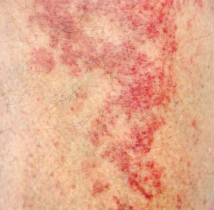 skin ageing - dermatitis