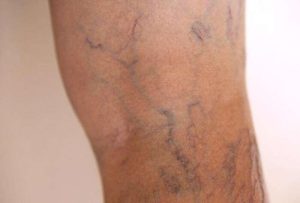 skin aging - varicose veins