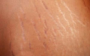 skin aging - stretch marks