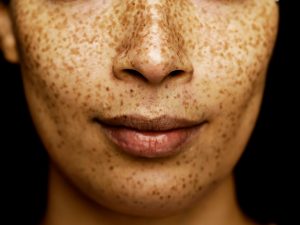 aging skin freckles