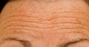aging skin wrinkles